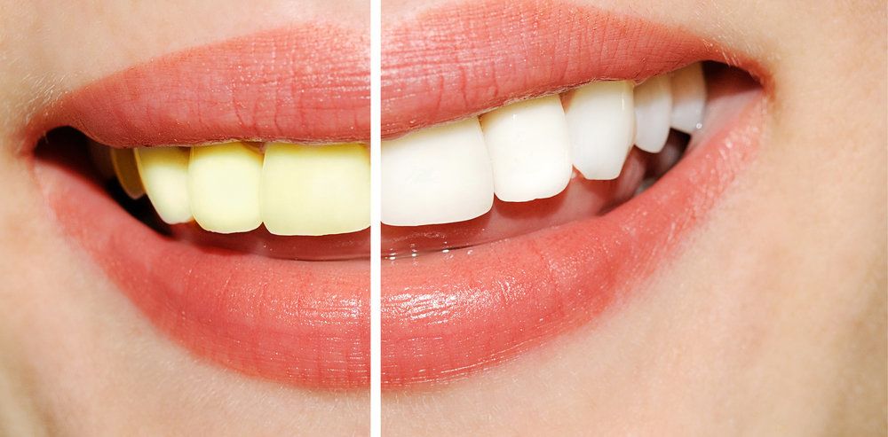 image of teeth whitening